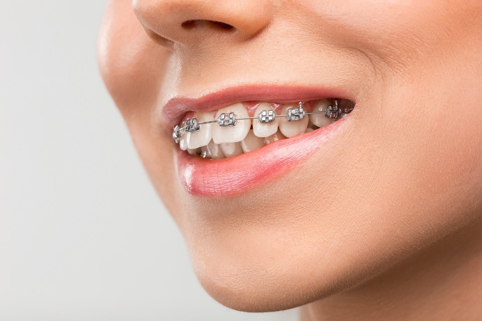 Patient after metal braces treatment